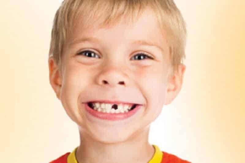 Que faire quand mon enfant a cassé ou perdu une dent définitive ?
