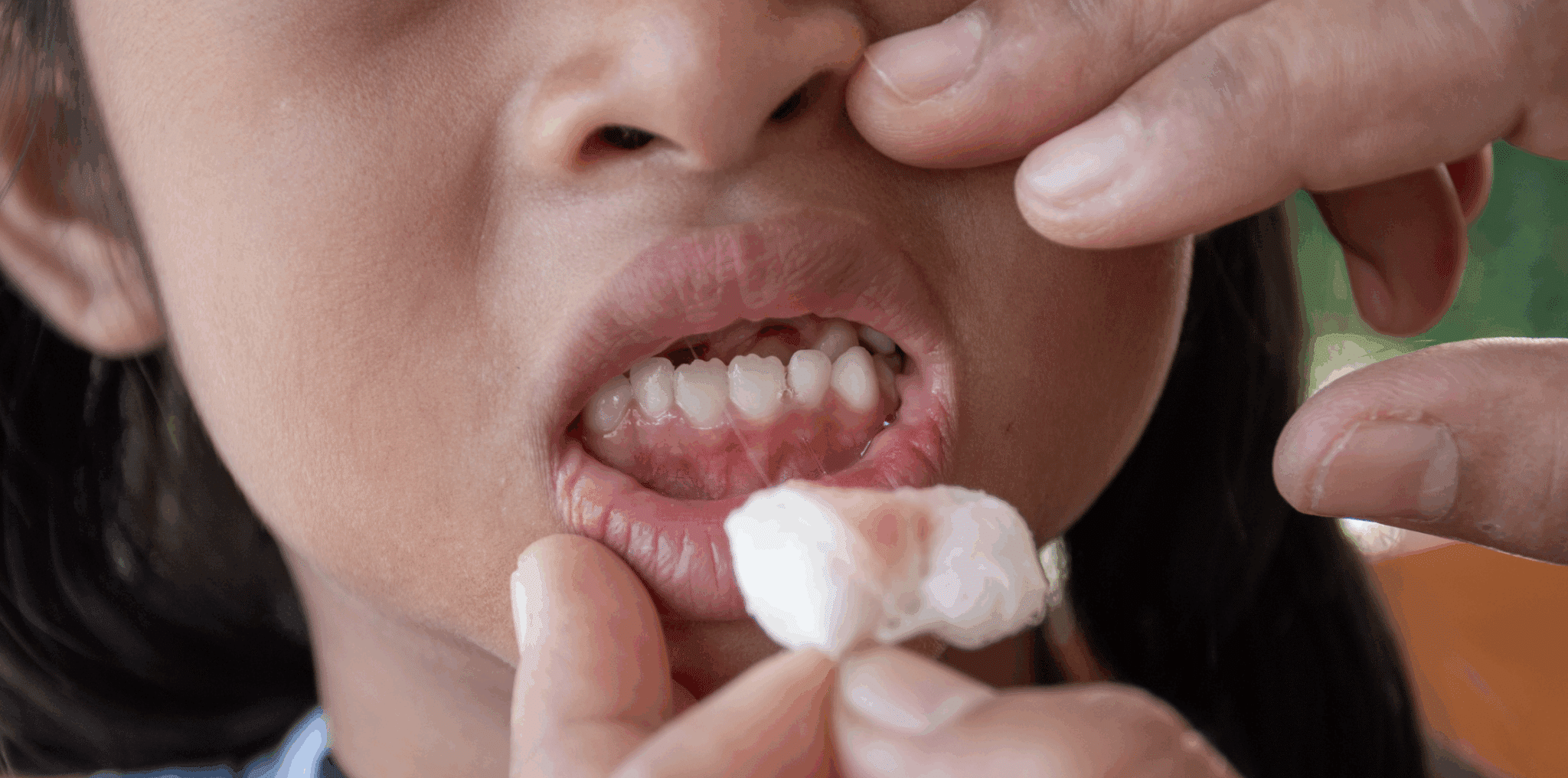 Mon enfant a les gencives qui saignent : est-ce normal ?