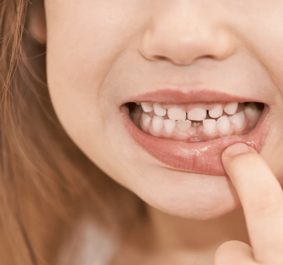Pourquoi une dent de lait peut-elle tomber prématurément ?