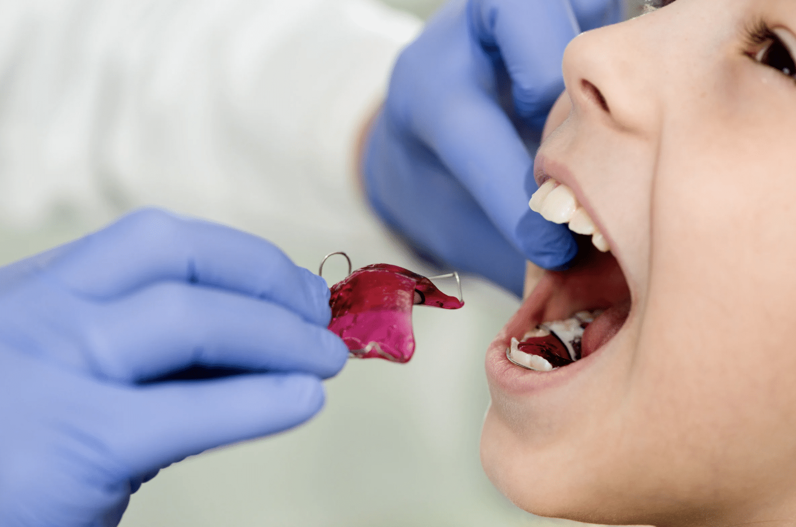 Comment entretenir un appareil dentaire chez l’enfant ?