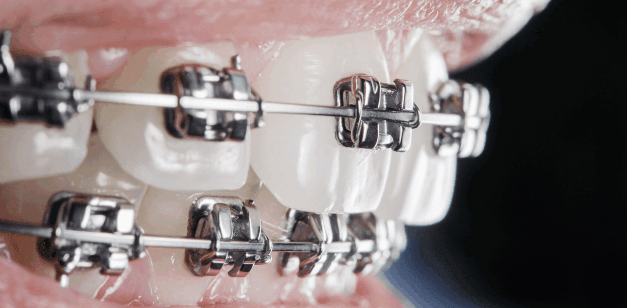 Quels sont les effets secondaires possibles d'un traitement orthodontique ?
