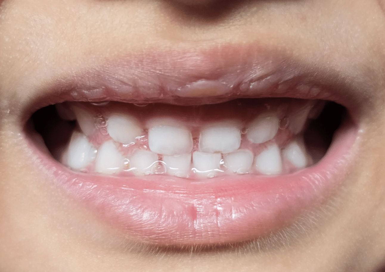 Les troubles de l’oralité peuvent-ils affecter la dentition ?