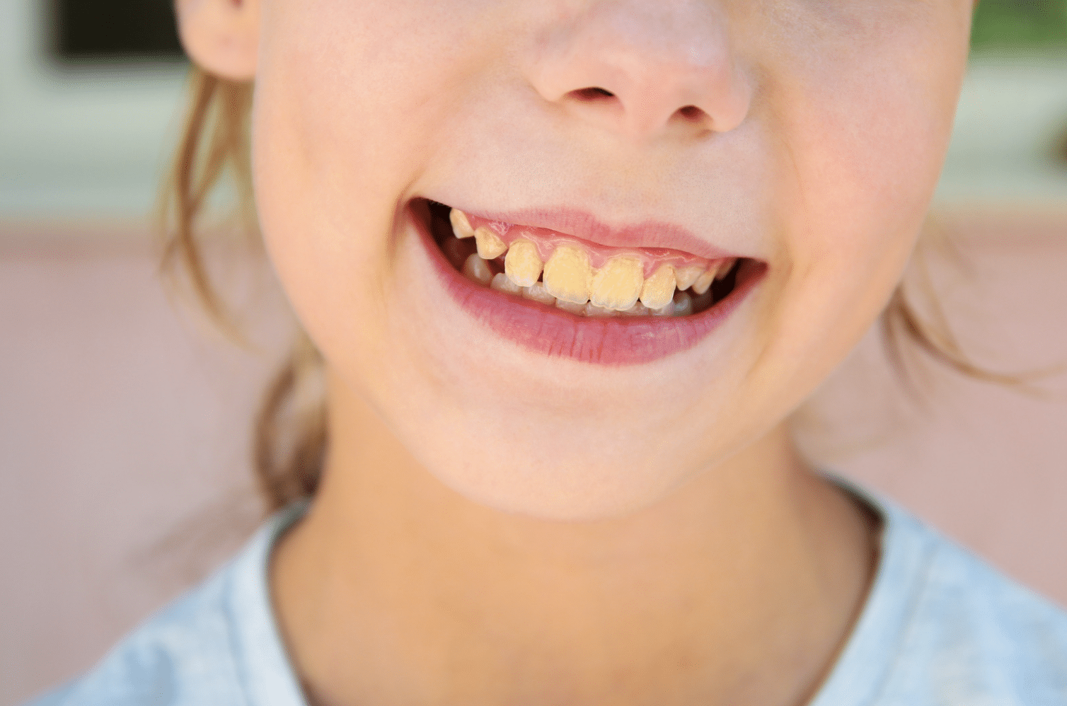 Pourquoi les dents de mon enfant sont-elles jaunes ?