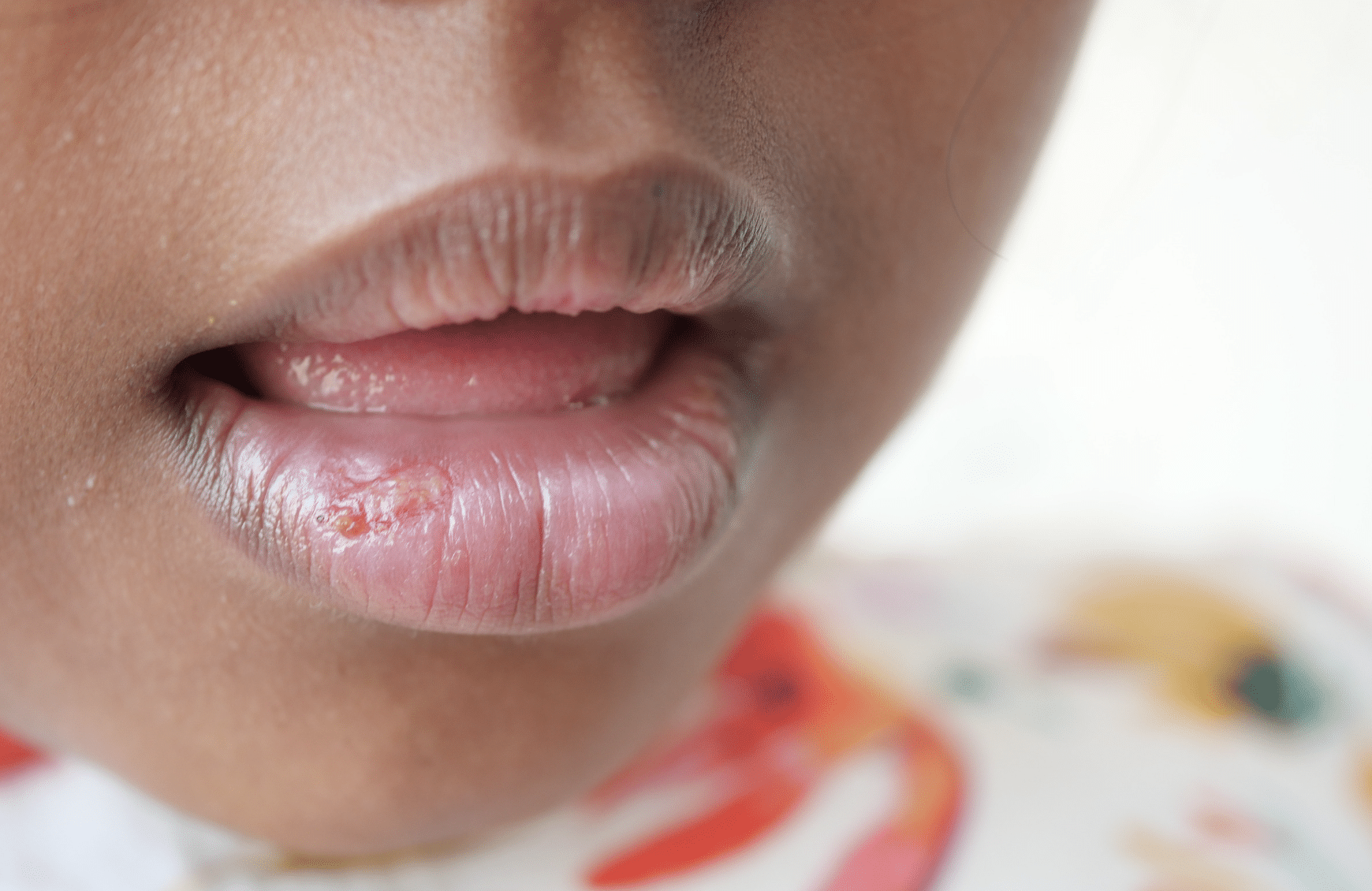 Mon enfant a les lèvres souvent gercées : y a-t-il un lien avec les dents ?