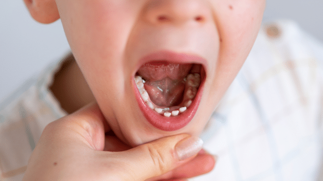 Les dents qui poussent « en grappe » sont-elles normales ?