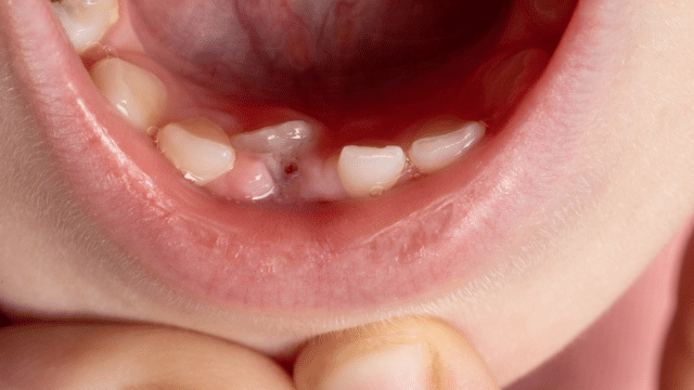 Pourquoi certaines dents poussent-elles derrière les dents de lait ?