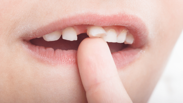 Les dents de lait peuvent-elles se recolorer naturellement ?